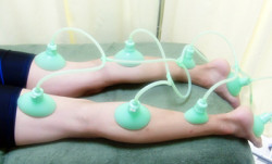 cupping_foot